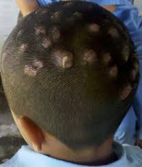 Image result for sores on the head in children