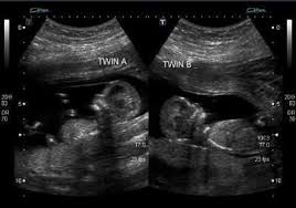 The average gestational age for twins at birth is 36 weeks. 140 My Ultrasound Board Ideas Ultrasound Ultrasound Pictures Baby Ultrasound