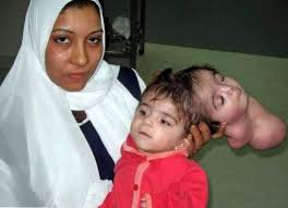 Ambras syndrome is a type congenital skin disease leads to unwarranted dense hair growth on the entire body, except in mucous membranes, soles, and palms. Top 10 Bizarre Geburtsfehler Gesundheit Beste Top 10 Listen Der Welt