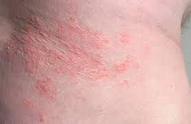 Mix one tablespoon of vinegar into one quart of lukewarm water. Inverse Psoriasis Vs Intertrigo Symptoms Causes And Identification