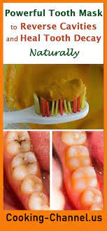 How To Heal A Cavity Naturally 5 Methods Recipes Page 2 Teeth Health Reverse Cavities Heal Cavities