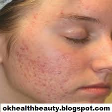 These tips and tricks will surely play a great role in enhancing your beauty. Chehre Ke Daag R Danny Khatam Karne K Totkay Face Pimples Remove Tips In Urdu Chehre Ke Daag Dhabe Door Karne Ka Tarika