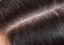 Food that helps you grow taller increase height. Balo Ka Dandruff Balon Ki Dekhbhal Kaise Karen Balo Ki Samasya Ka Samadhan In Hindi Hair Dandruff Remove Tips In Urdu