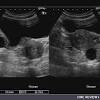 There are several types of ovarian cysts, and they can occur during pregnancy, menopause, and. 1