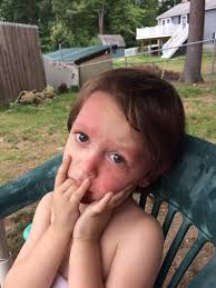 Hi... my name is Sophie I have SWS. I am 19 years old. I have had a port  wine stain birthmark since birth. When I was little my PWS didn't bother me