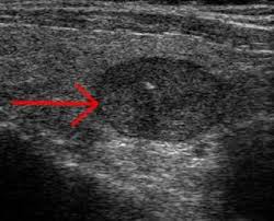 Following Thyroid Nodules With Ultrasound Jeffrey Dach Md Thyroid Nodules Thyroid Ultrasound