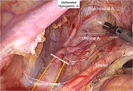 However, the same basic principle of understanding the relationship between important. Surgical Pelvic Anatomy In Gynecologic Oncology Puntambekar 2018 International Journal Of Gynecology Amp Obstetrics Wiley Online Library