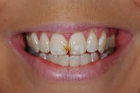 Pin On Tooth Decay Nutrition