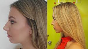 Ahead, 13 celebrities talk about their nose job experiences. To Anyone Considering Plastic Surgery Read This First