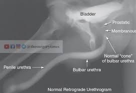Image result for Retrograde Urethrogram