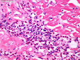 From animal models of cardiac inflammation we have detailed insight of the strain specific immune. Webpathology Com A Collection Of Surgical Pathology Images