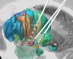 Dbs also maintains the adults' and children's barred lists and makes considered decisions as to whether an individual should be included on one or both of these lists and barred from engaging in. Lead Dbs A Matlab Toolbox Reconstruction And Visualization Of Dbs Electrodes Based On Postoperative Imaging
