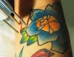 Trusted tattoo removal specialist serving pittsburgh, pa. Pittsburgh Laser Tattoo Removal Astanza Duality Laser