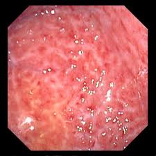 Erkennt man rote blutbeimischungen im stuhl spricht man von einer hämatochezie (synonyme. Gastritis Verdauungsstorungen Msd Manual Ausgabe Fur Patienten