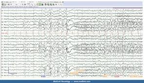 His place manhwa also known as (aka) his place {acera} ; Eeg In Epilepsy Medlink Neurology