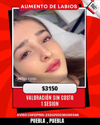 🌟 Aumento de labios