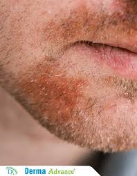 Image result for Beard Dermatitis
