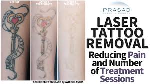 How painful is tattoo removal? How Tattoos Removal Can Be Done With Less Pain And Fewer Treatment Sessions Youtube