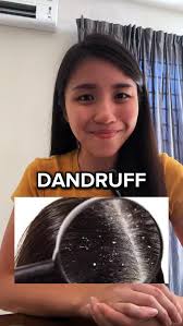 Dandruff