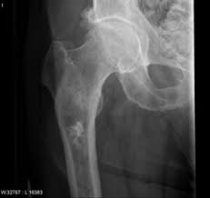 Image result for Chondrosarcoma