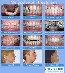 Malocclusion Treatment Orthodontics Periodontitis Dental Assistant