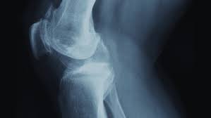 Image result for Knee XRay