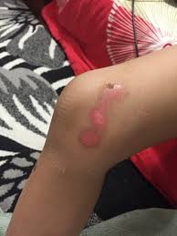 Lutut bengkak karena jatuh dari motor. Luka Jatuh Dari Motor Di Kaki Paimin Gambar