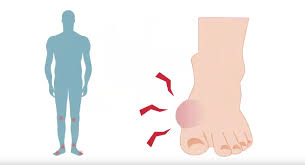 Aquí está el mejor invento del hombre: Gota Que Es Sintomas Diagnostico Y Tratamiento De La Enfermedad