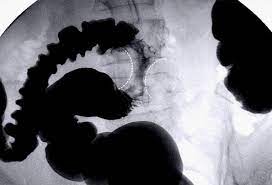 Is it different from colorectal cancer? Tumors On A Cats Colon Bennetfrye S Blog