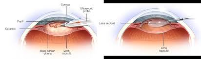 Image result for Cataract Extraction