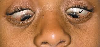 Image result for Vernal Conjunctivitis