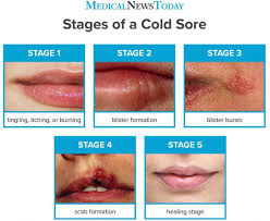 I am leaving for the beach tomorrow and want to know if there is a way to heal the cold sore scab any faster? answered by dr. How Long Do Cold Sores Last Stages Pictures And Treatments