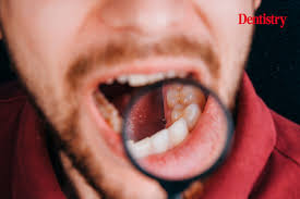 Image result for gums cancer symptoms
