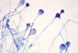 Une maladie cryptogamique, ou maladie fongique, est une maladie causée à une plante par un champignon ou un autre organisme filamenteux (cas des oomycetes) parasite. Covid En Inde Le Diabete Est Il A L Origine Du Nombre Eleve De Cas De Champignons Noirs Bbc News Afrique