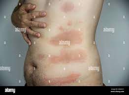 Hombre Para Tener Sarpullido Rojo En Su Cuerpo Parte Personas Con Alergia Cutanea Problema Concepto Fotografia De Stock Alamy