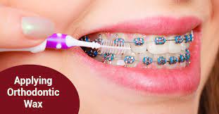 :( my orthodondist gave me wax to relieve the pain, but i don't know how to use it? How To Apply Orthodontic Wax David Silberman Dds