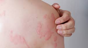 Image result for Papular urticaria