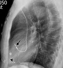 Paces the heart muscles by providing an electrical. Radiography Of Cardiac Conduction Devices A Comprehensive Review Radiographics