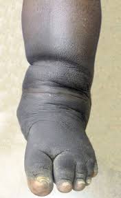 If not caught in its earliest stage, the joints in the foot collapse and the foot eventually becomes deformed. Differential Diagnosis Of Charcot Arthropathy Lower Extremity Review Magazine