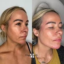 𝑶𝒃𝒔𝒆𝒔𝒔𝒆𝒅 𝒘𝒊𝒕𝒉 𝒉𝒆𝒓 𝒈𝒍𝒐𝒘－𝒖𝒑 ! 💎💫 Facial harmonization  🫶🏻