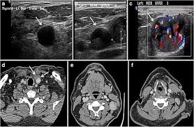 To diagnose thyroid nodules or cancers, your doctor performs a physical exam, takes a medical history, and asks about your symptoms. Computed Tomography Of The Thyroid Wikipedia