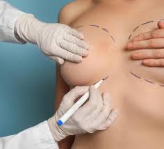 Reducción de pecho: ¿qué mujeres se someten a este tipo de cirugía? -  Cirugía de mamas