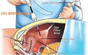 We did not find results for: Laparoscopy Surgery Cost In Electronic City Find Best Surgeons Reviews And Book Appointment Laparoscopy Surgery