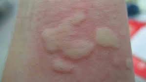 Ubat hives, ubat hiv rash, ubat hiv aids, ubat hiv virus, ubat hiv cure, ubat hiv medications, ubat hive ip, ubat hiv treatment, ubat hiv testing, ubat hiv vaccine, kesan awal dijangkiti penyakit hiv aids, wajib baca via www.encikshino.com. 7 Punca Gegata Pada Anak Cara Betul Nak Hilangkannya Bukan Sebab Dijilat Jin