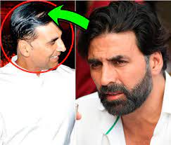 We look at the various causes, treatment possible causes of hair loss include androgenetic alopecia, pregnancy, and telogen effluvium. Celebrity Hair Transplant Bollywood Actors Who Went For Hair Transplant