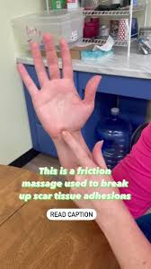 Can you tell which hip was fractured???" Earl Heim came to us limping,  unable to dance or perform activities related to work. He leaves us today  with...