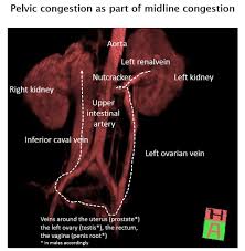 Pelvic Congestion Syndrome