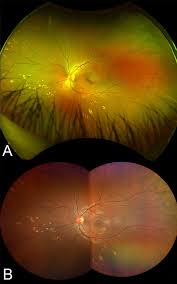 The optomap® retinal exam produces an image that is as unique as you fingerprint and provides us with a wide view to look at the health of your retina. Widefield And Ultra Widefield Imaging When And Why To Use Them