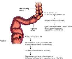 Rectal cancer based on their origin, symptoms, diagnosis and treatment. Cancers Of The Colon And Rectum Identical Or Fraternal Twins Cancer Discovery