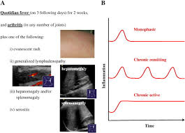 Sjia is listed in the world's largest and most authoritative dictionary database of abbreviations and acronyms. Current Understanding Of The Pathophysiology Of Systemic Juvenile Idiopathic Arthritis Sjia And Target Directed Therapeutic Approaches Sciencedirect